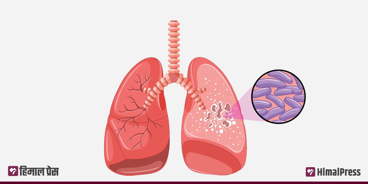 तनहुँमा तीन सय बढी क्षयरोगी
